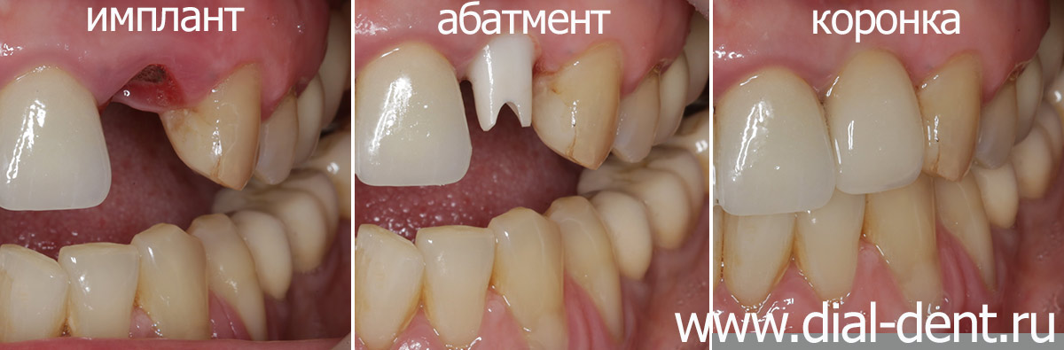 протезирование переднего зуба на импланте
