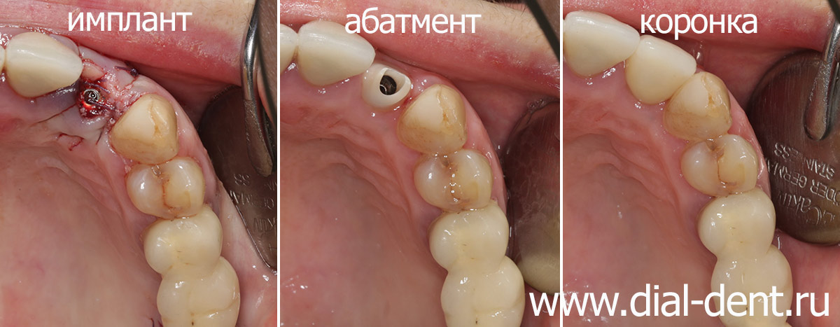 протезирование переднего зуба на импланте