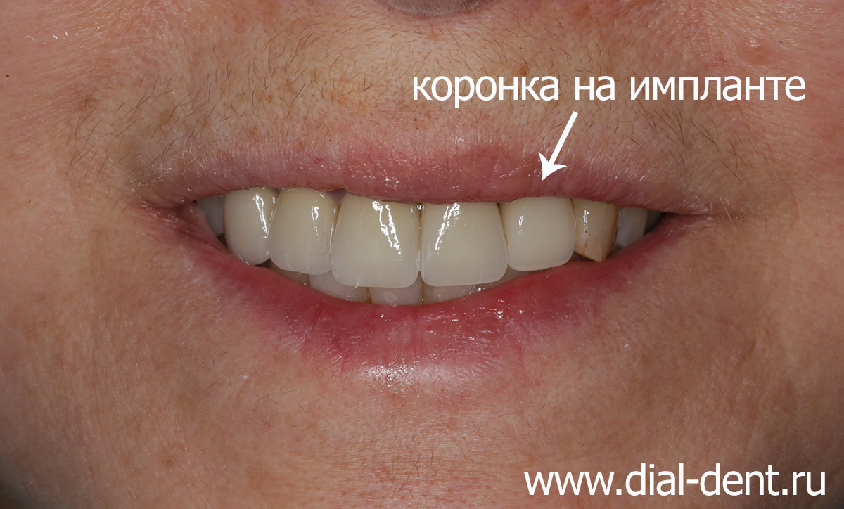 фото после протезирования зуба