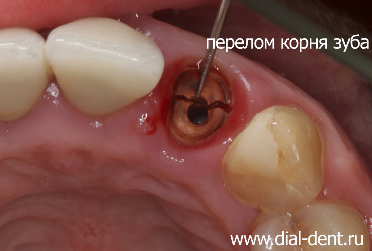 фото перелом корня зуба