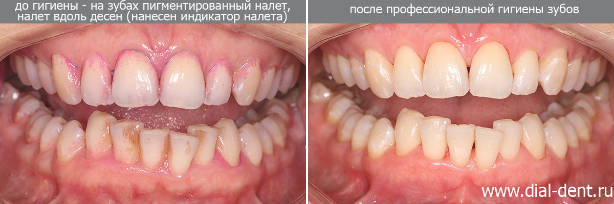 профессиональная гигиена полости рта - до и после процедуры