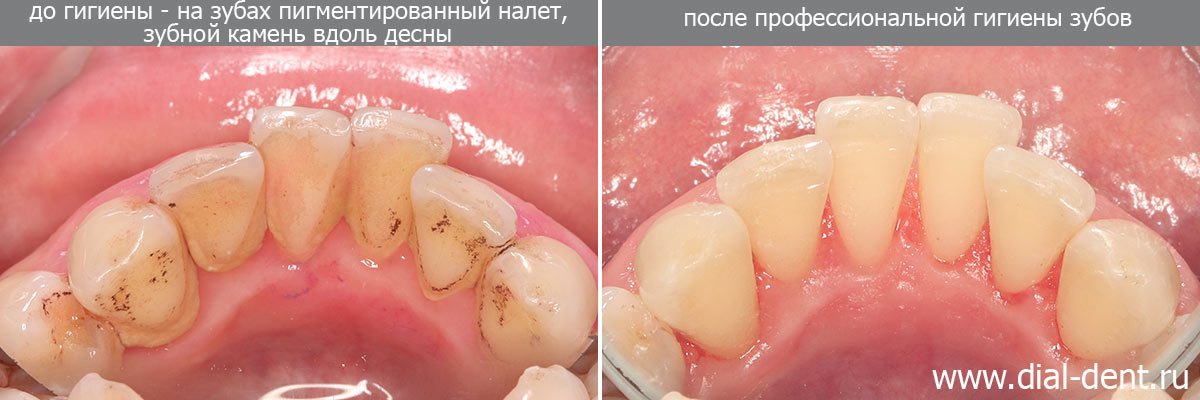удаление зубного камня и пигментированного налета