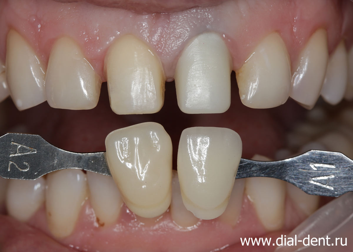 подготовка зубов под керамические реставрации и подбор цвета реставраций