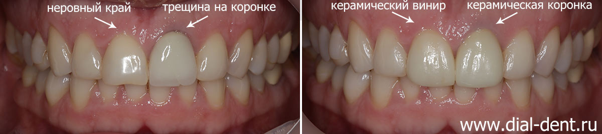 до и после реставрации передних верхних зубов