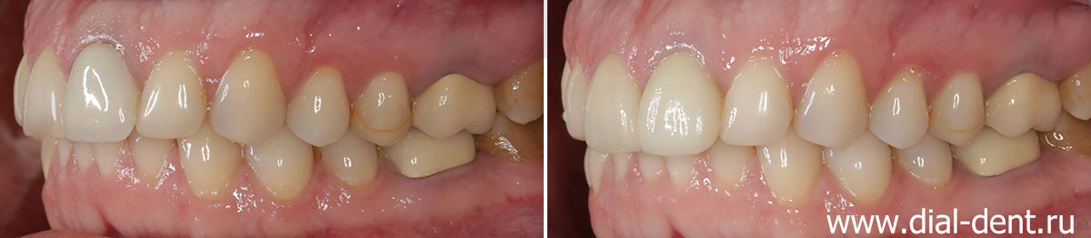 до и после реставрации передних верхних зубов