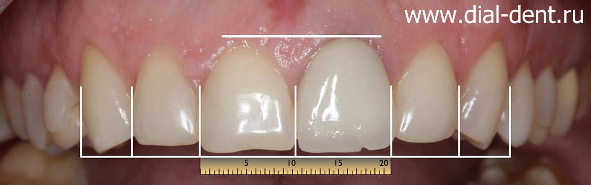 планирование реставрации передних зубов