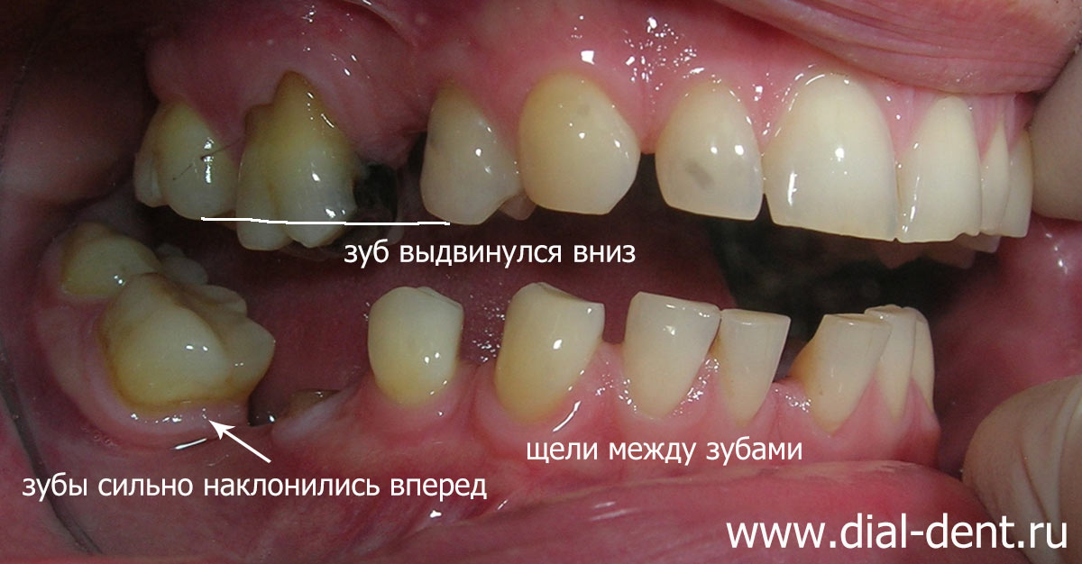 вид зубов до лечения