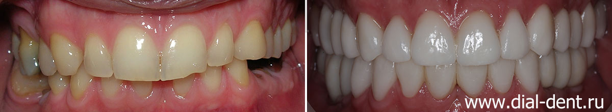 фото до и после имплантации и протезирования зубов