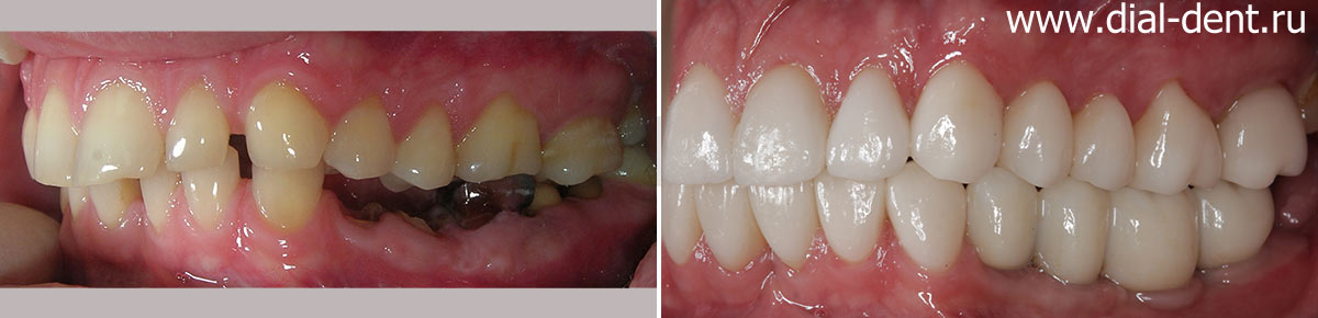 вид зубов слева до и после имплантации и протезирования
