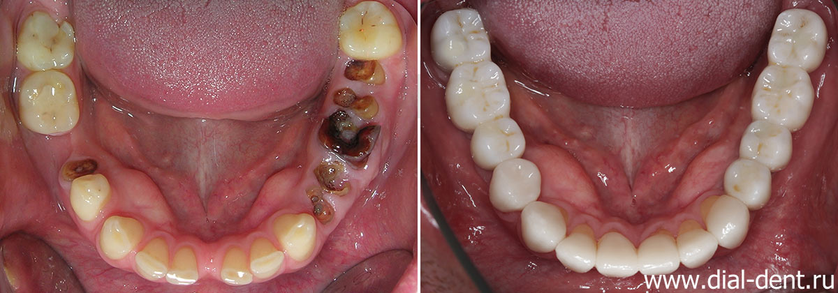 нижние зубов до и после имплантации и протезирования