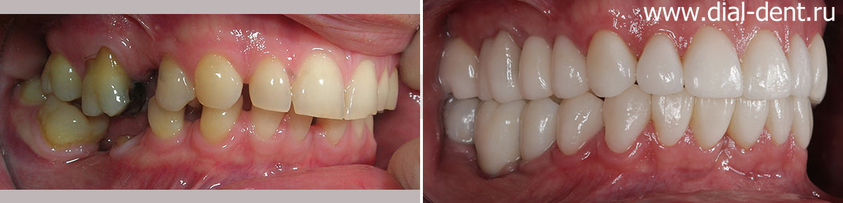 вид зубов справа до и после имплантации и протезирования