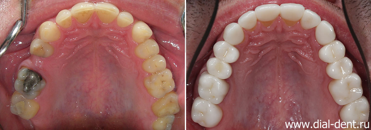 верхние зубов до и после имплантации и протезирования