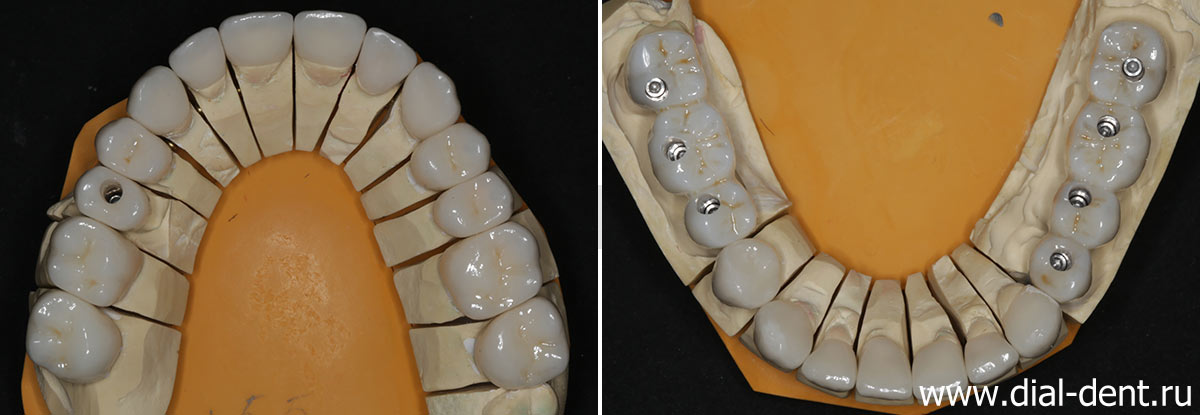 керамические коронки на модели зубов