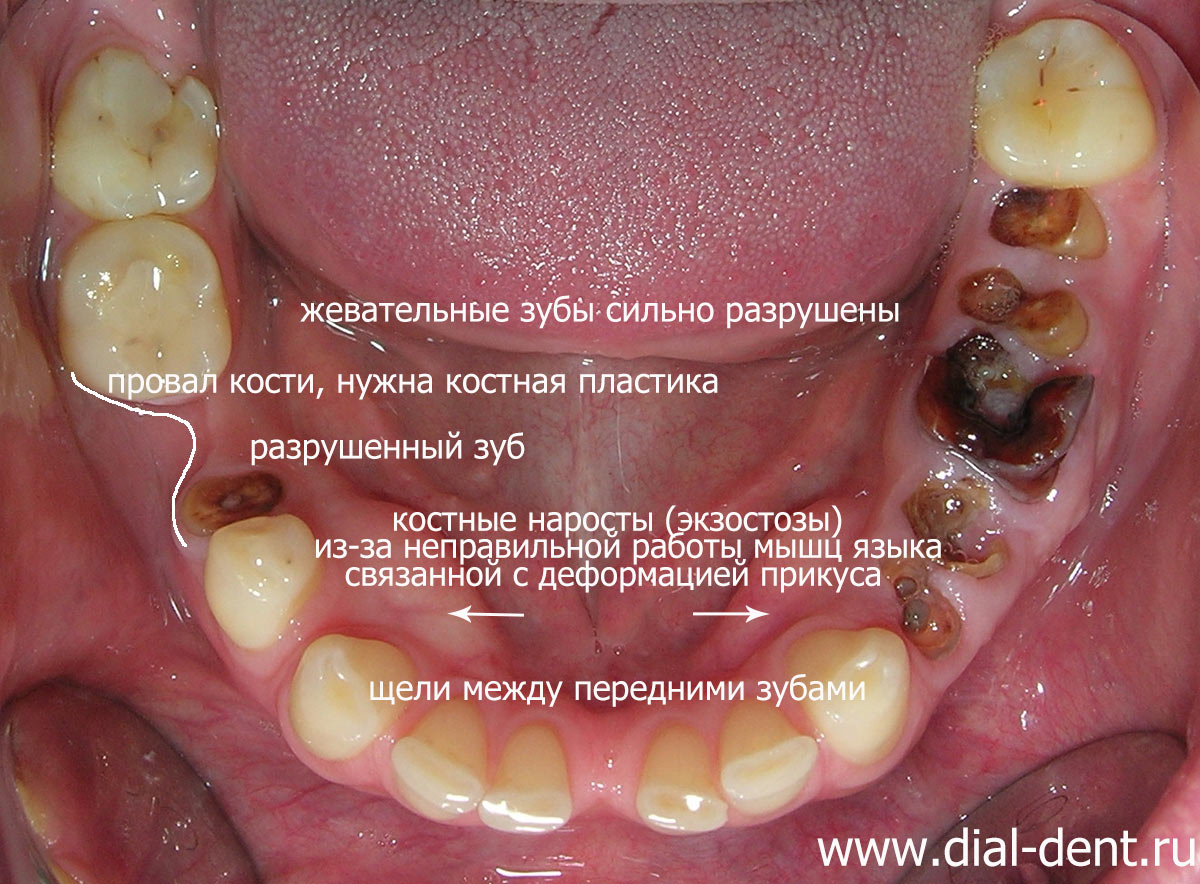 вид нижних зубов до лечения