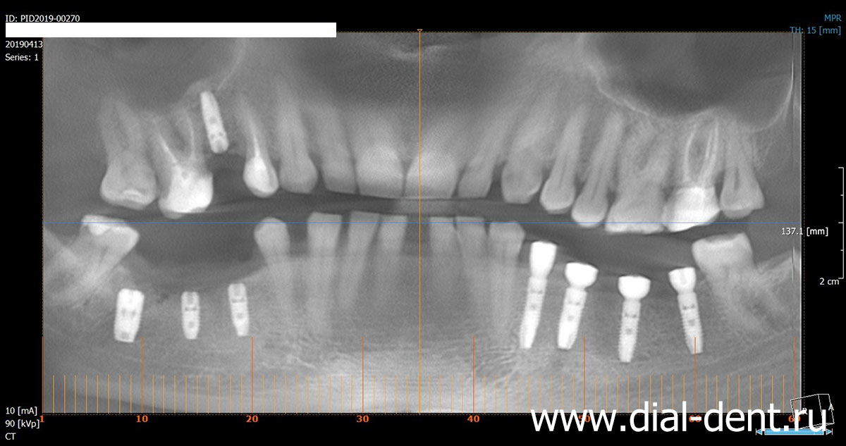панорамный снимок зубов после установки имплантов