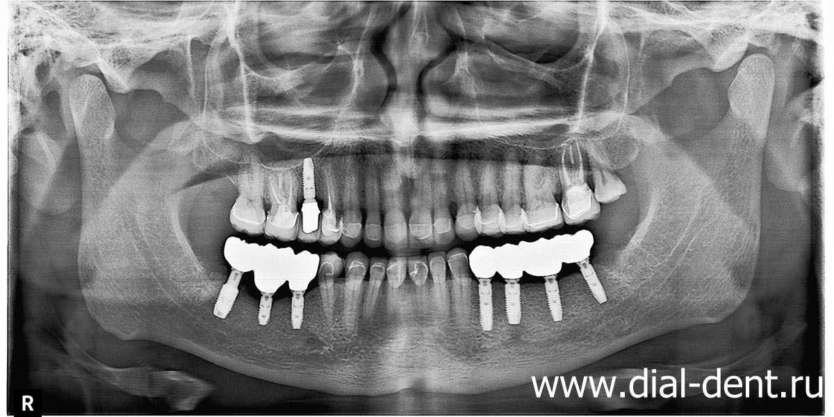 панорамный снимок зубов после окончания имплантации и протезирования зубов