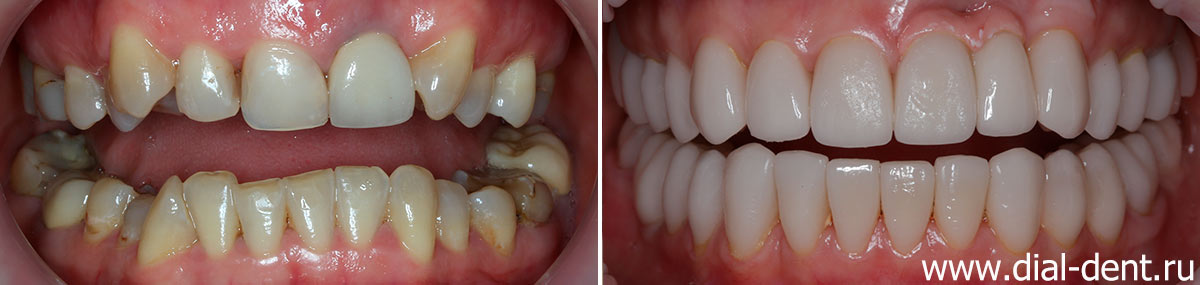 фото зубов до и после исправления прикуса и протезирования керамикой