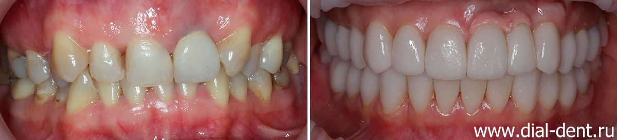 вид зубов до и после исправления прикуса и протезирования