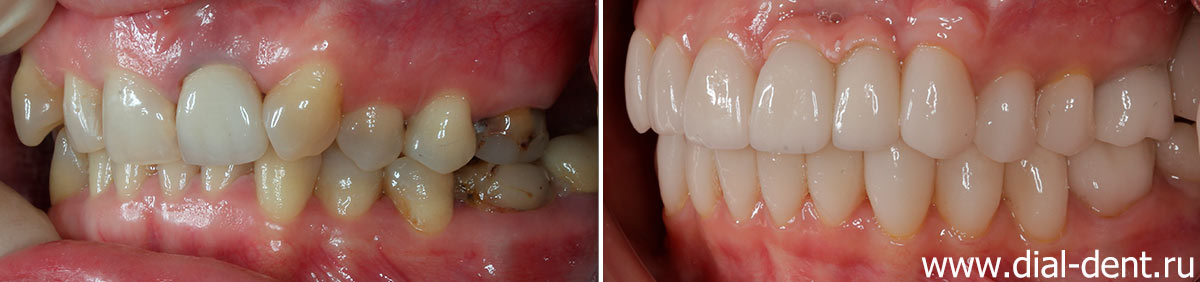 фото зубов до и после исправления прикуса и протезирования керамикой