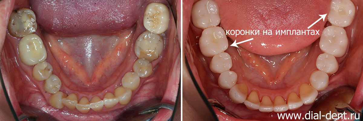 вид нижних зубов до и после исправления прикуса и протезирования
