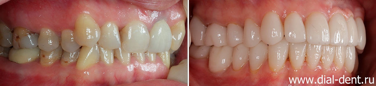 фото зубов до и после лечения