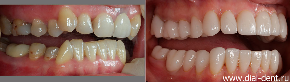фото зубов до и после лечения