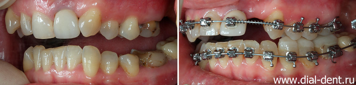 фото зубов с брекетами - вид слева 