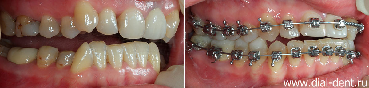фото зубов с брекетами - вид справа
