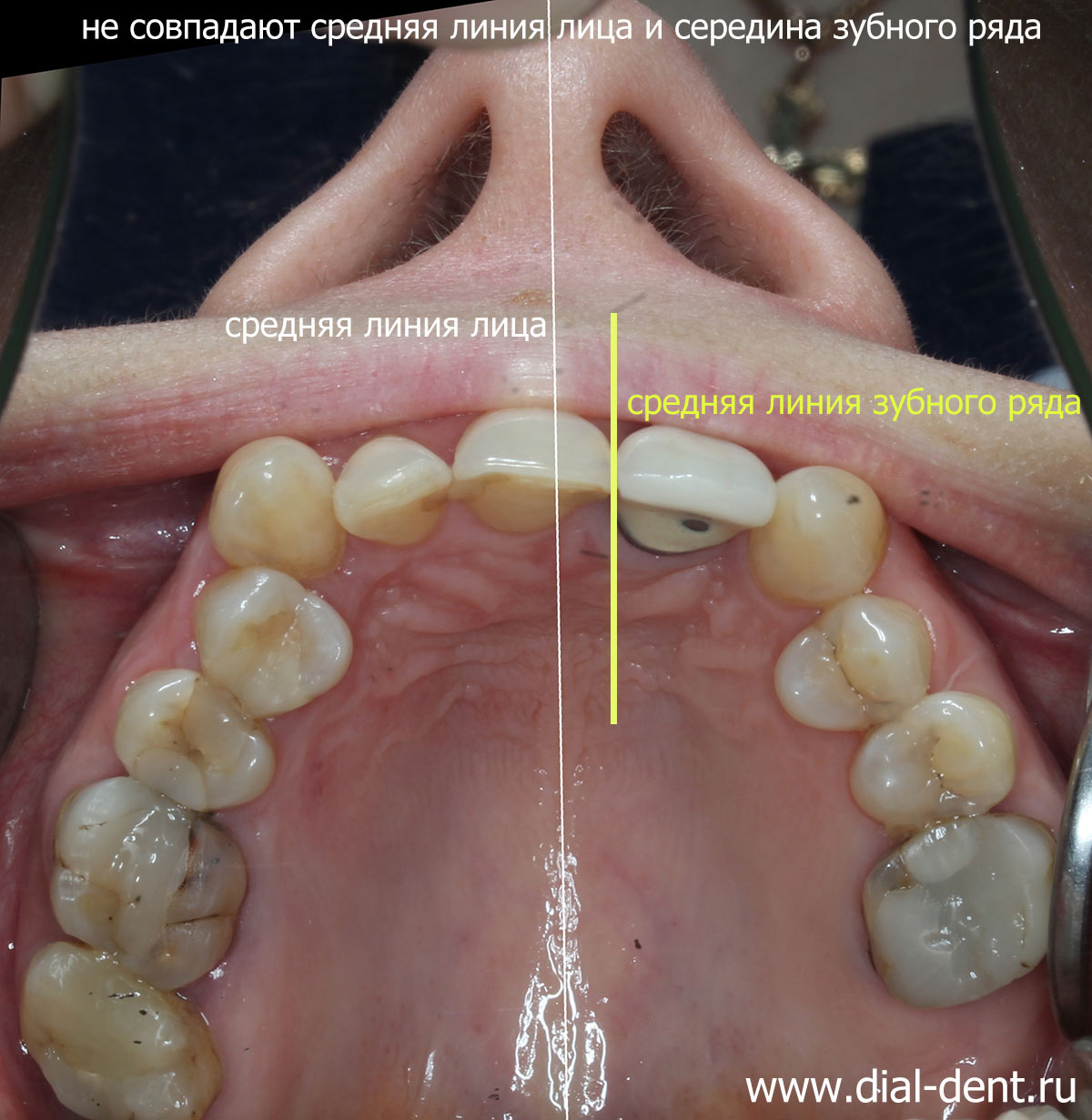 несовпадение средних линий лица и зубов