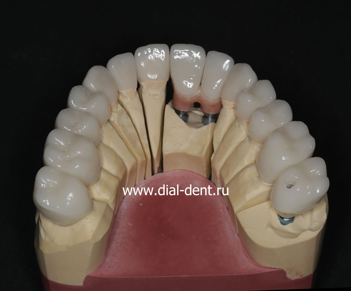 зубные коронки на модели в лаборатории