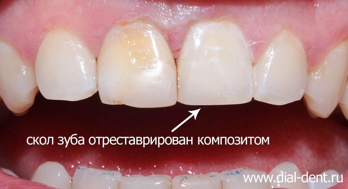 реставрация скола зуба фото