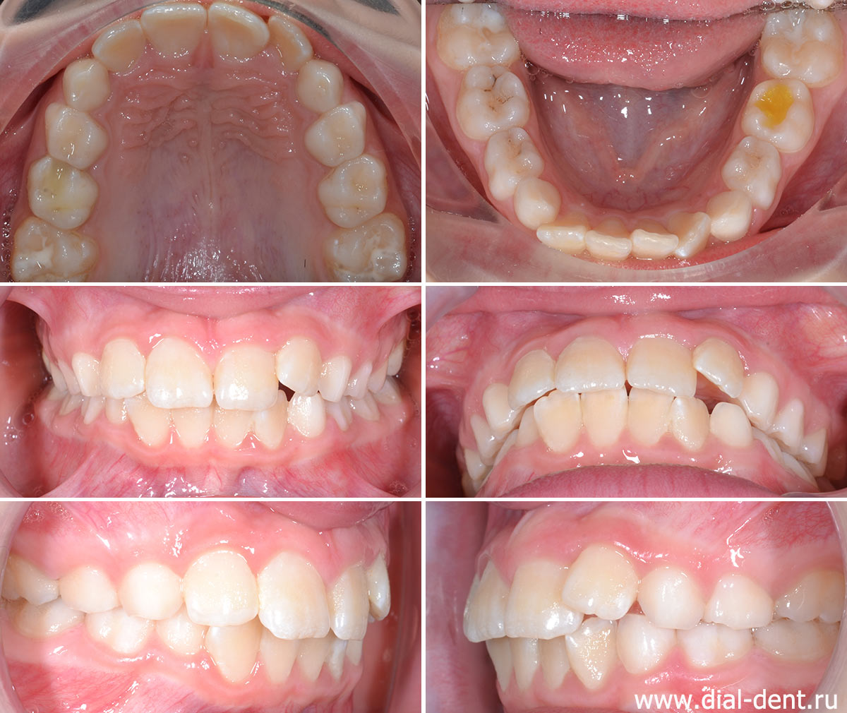 вид зубов до начала ортодонтического лечения ребенка
