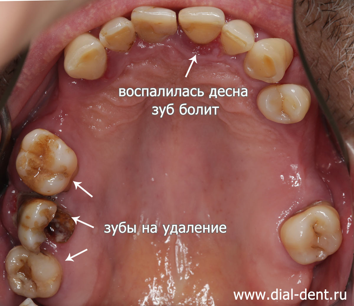 пародонтит, воспаление десны, шатаются зубы