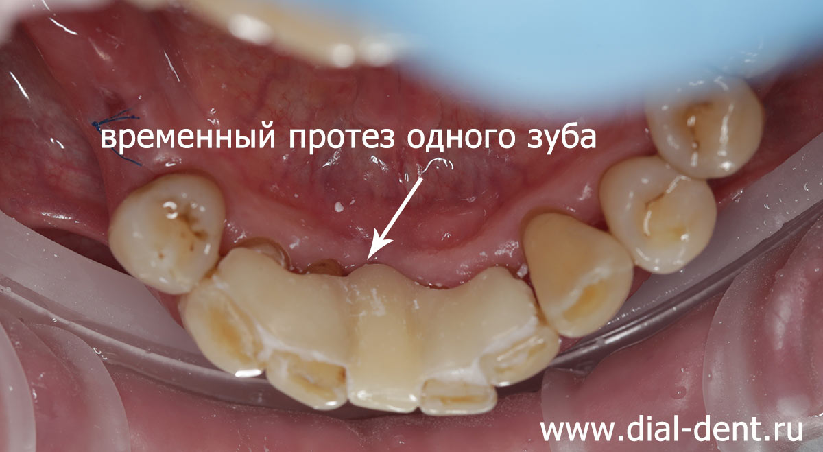 временный протез переднего зуба