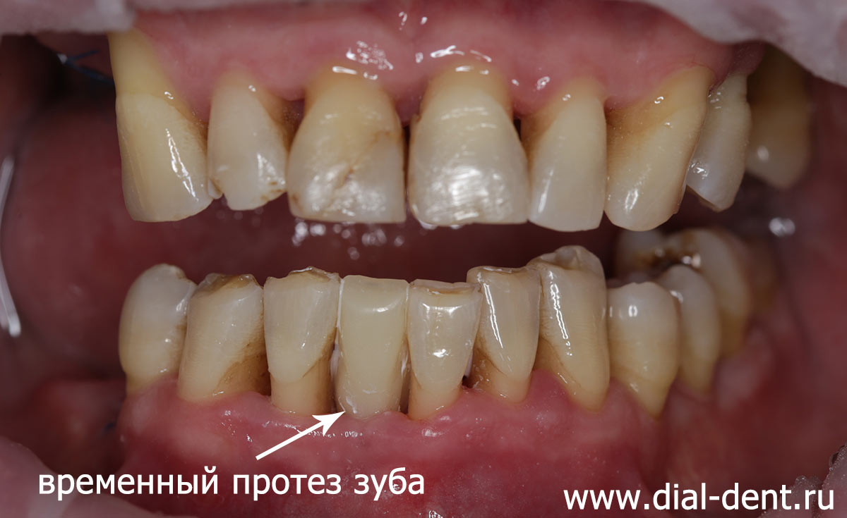 временный протез переднего зуба