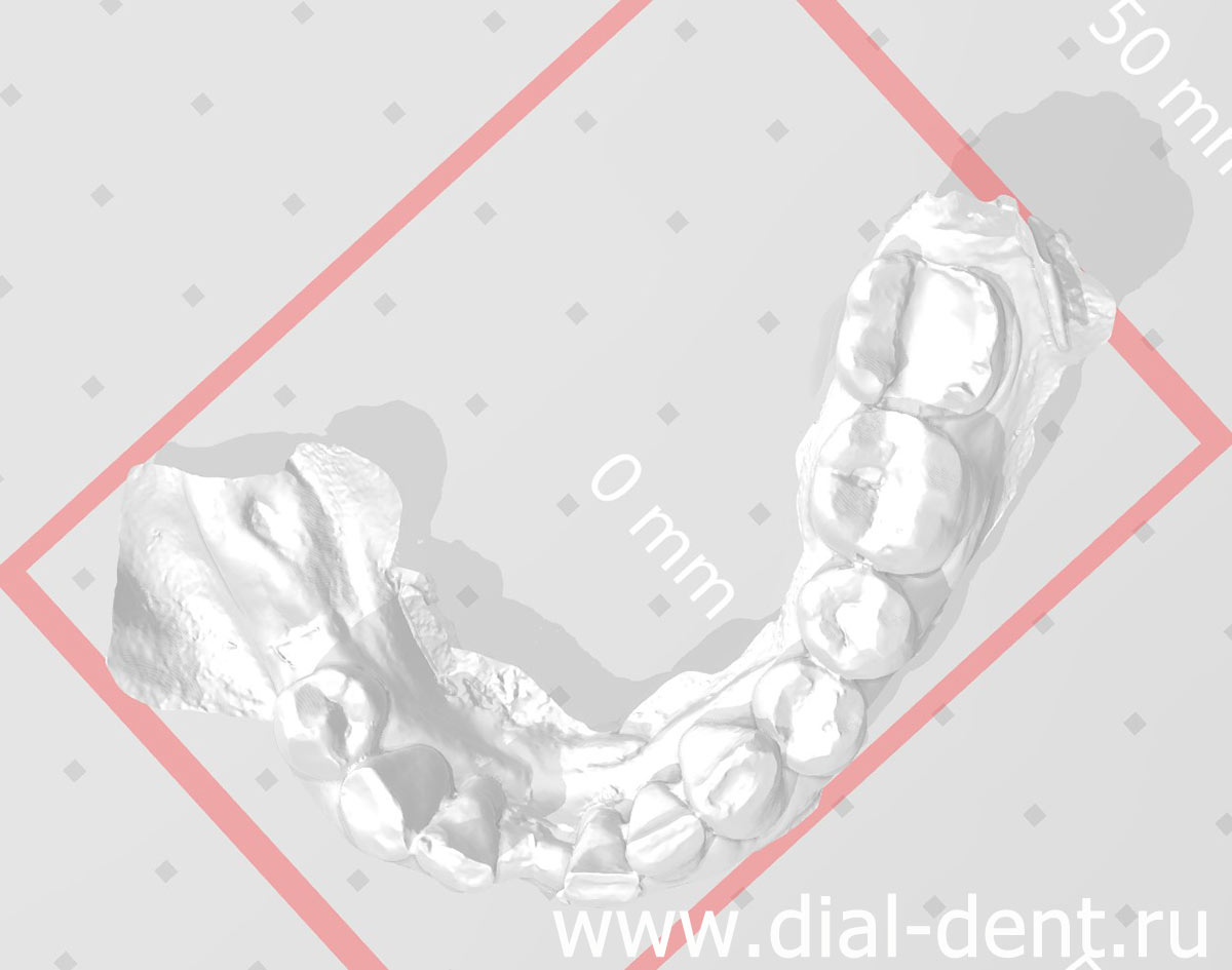 сканирование зубов