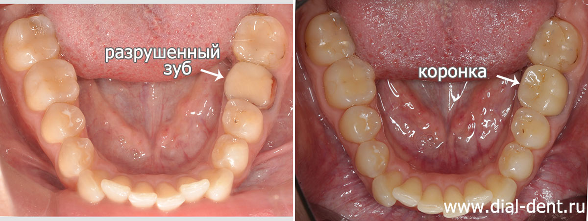 нижние зубы до и после установки коронки