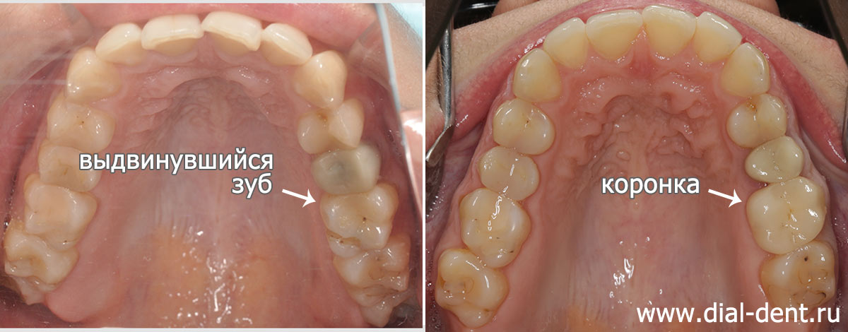 верхние зубы до и после установки коронки