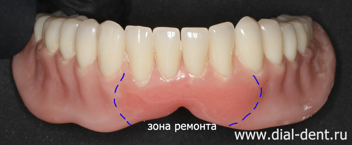 съемный зубной протез после ремонта