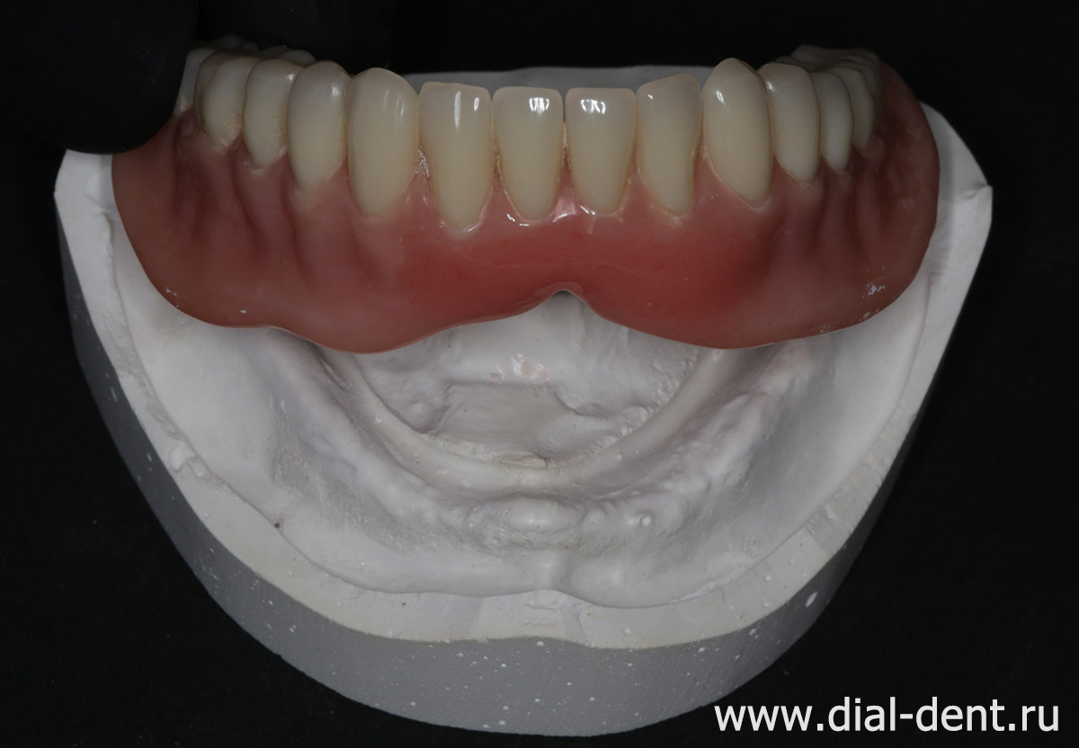 съемный зубной протез после ремонта на модели челюсти