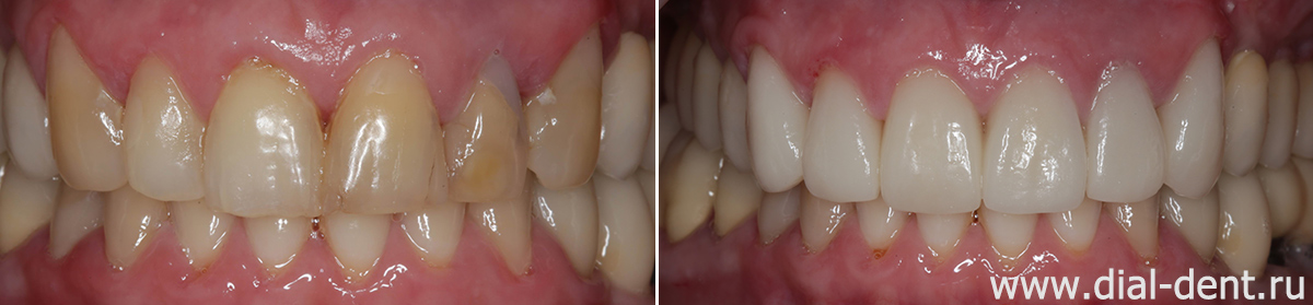 вид зубов до и после протезирования верхних зубов керамикой