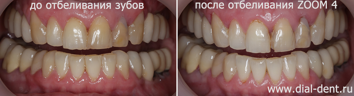 до и после отбеливания зубов ZOOM 4