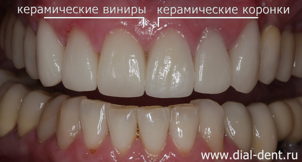 протезирование передних верхних зубов керамикой