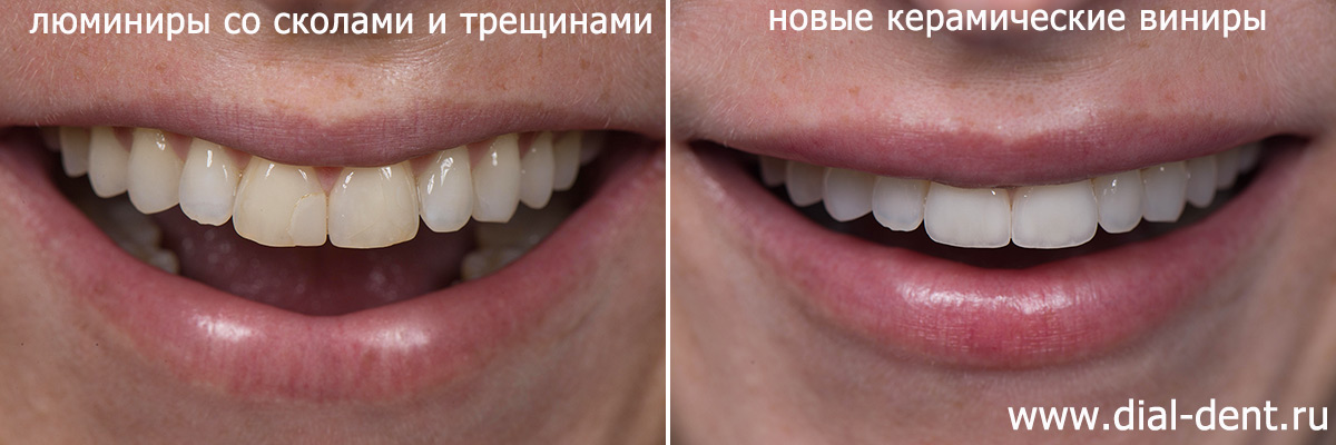 улыбка до и после реставрации передних зубов винирами