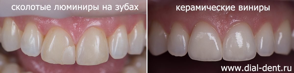 фото до и после реставрации зубов винирами