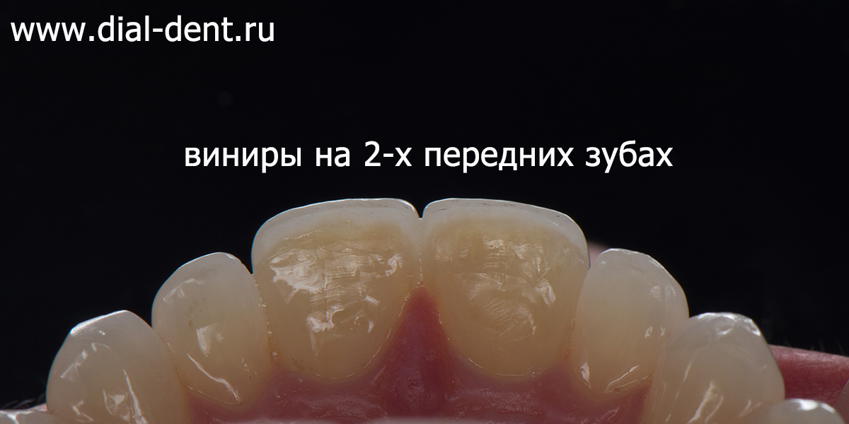 керамические виниры установлены на 2 передних зуба