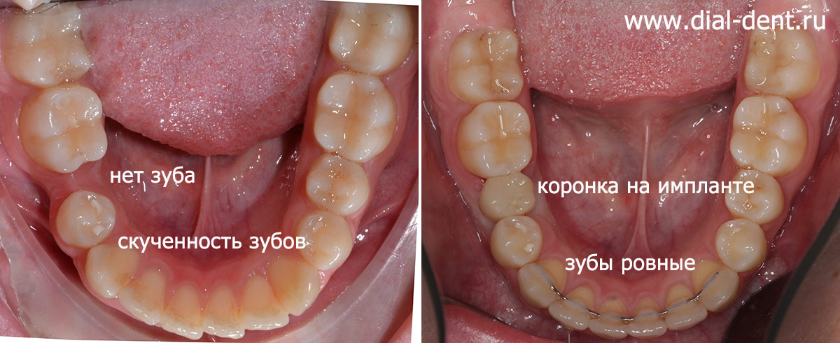 до и после исправления прикуса и протезирования зубов