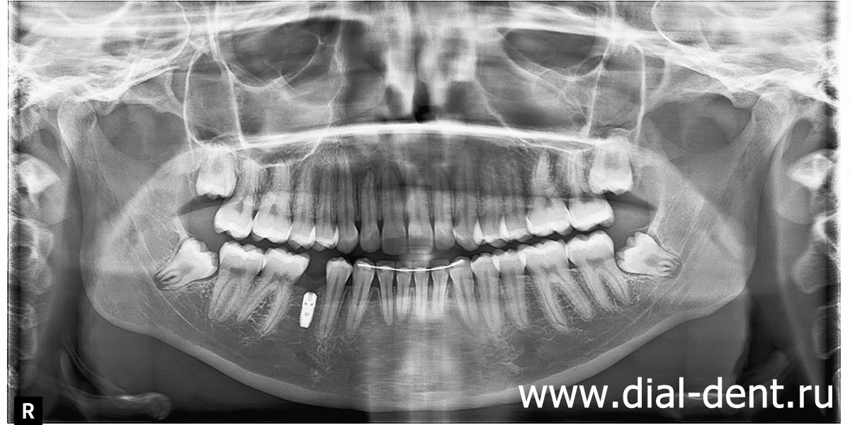 панорамный снимок зубов после имплантации