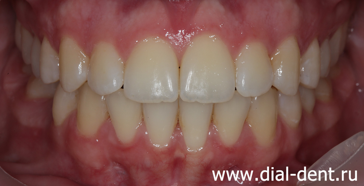 ровные зубы после исправления прикуса в Диал-Дент