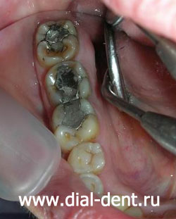 старые пломбы, множественные дефекты на жевательных зубах